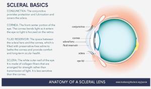 Side view of an eye showing the cornea, sclera, conjunctiva, and fluid reservoir of a scleral lens