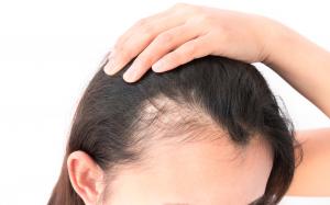 Women’s Hair Loss – New Information & Technology. Nationally Renowned, Dr. Puig Discusses Causes and Treatments.
