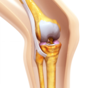 Robotic Knee Replacement Technology to Bolster US Large Joint Devices Market