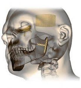 Global Craniomaxillofacial (CMF) Devices Market 2022