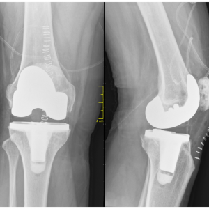 Global large joints