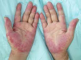 Chemotherapy-Induced Acral Erythema Treatment Market