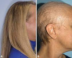 chemotherapy-induced-alopecia-treatment-market