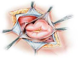 Laparoscopic and Open Hernia Mesh Repair Surgery Market