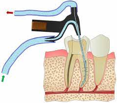 Root Canal Irrigant Market