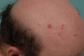 Basal Cell Nevus Syndrome Drug Market