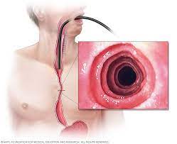 Eosinophilic Esophagitis Drug Market