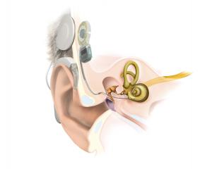 Cochlear Implant market Developments, Key Players and Forecast to 2031