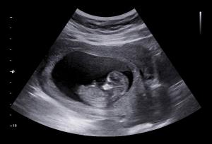Ultrasound Market
