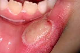 Mouth Ulcer Market Forecast | Present Scenario of Manufacturers By 2031