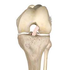 Ligament Prostheses