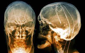 Deep Brain Stimulation Market