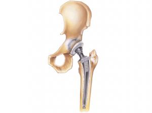 Bone Replacement Market