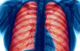 Chronic Obstructive Pulmonary Disorder (COPD)