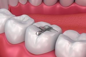 Dental Fillings Market
