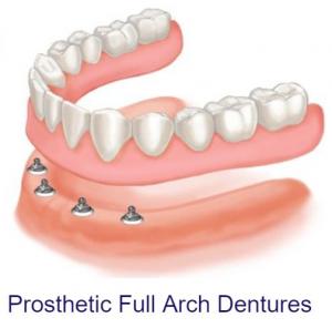 Prosthetic Full Arch Dentures Market