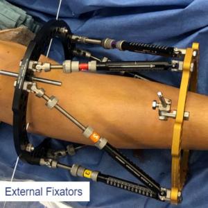 External Fixators Market