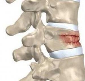 Vertebral Fracture