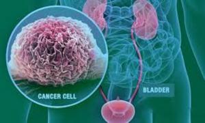 Bladder Cancer Therapeutics Market