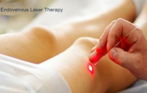 Endovenous LaserTherapy Market