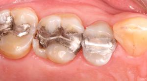 Dental Mercury Amalgam Fillings