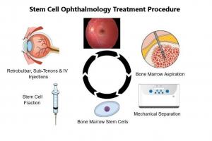 SCOTS2 Eye Treatment showing bone marrow, separation, and orbital placement of stem cells