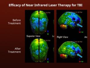 This chart shows brain damage can be reversed with a new treatment from Neuro-Laser Foundation.