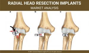 Radial Head Resection Implants