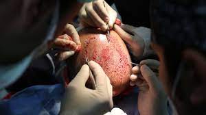 Global Hair Transplant Devices Market