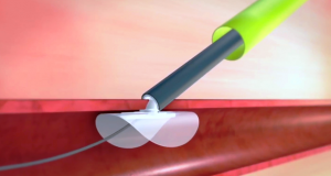 Peripheral Vascular Devices