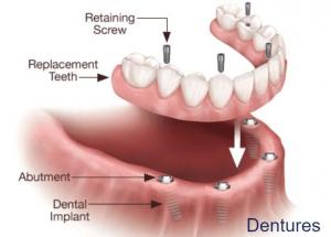 Dentures Market Industry