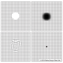 Amsler Grid abnormalities can indicate macular problems such as diabetic macular edema or age-related macular degeneration
