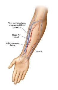 Arteriovenous Fistula Treatment Market