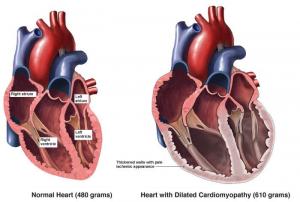 Cardiomyopathy Market