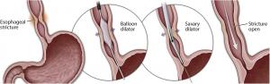 Gastrointestinal Endoscopy Stricture Management Devices Market