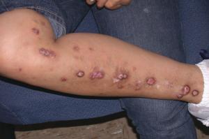 Prurigo Nodularis Treatment Market