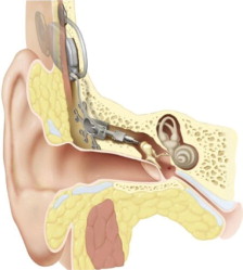 Middle Ear Implants Market