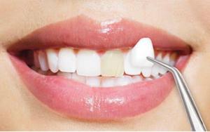 Dental Veneers market