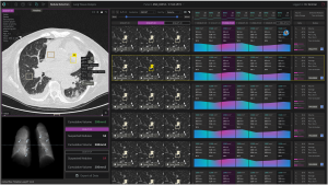 The UI from contextflow's TIMELINE feature, which shows radiologists changes in lung nodules over time