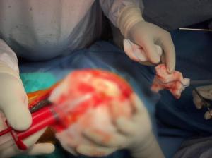 cartilage transplant surgery