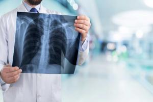 Lung CT market