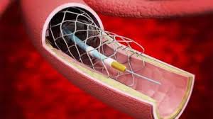 Global Vascular Stent Market Size