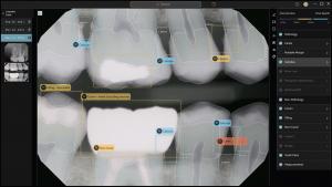Dental Second Opinion, Teledentists, Dentulu, Telemedicine, Pearl AI