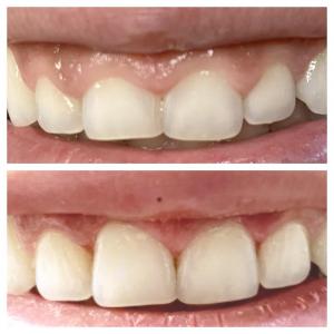 Gingival contouring, gum reshaping, cosmetic dentistry, dental aesthetics, periodontal treatment, professional dental care, healthy gums, beautiful smile