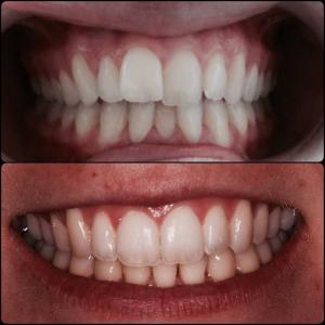 Invisalign braces, clear aligners, orthodontic treatment, straight teeth, cosmetic dentistry, clear aligner therapy, alternative to traditional braces, comfortable, invisible