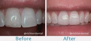 Veneers, cosmetic dentistry, porcelain veneers, dental veneers, teeth veneers, teeth restoration, teeth reshaping, smile makeover, dental laminates, teeth whitening, dental bonding, dental contouring, teeth covering, dental aesthetics