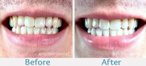 Teeth Whitening, cosmetic dentistry, tooth bleaching, professional teeth whitening, in-office teeth whitening, take-home teeth whitening, teeth whitening gel, teeth whitening trays, teeth whitening kit, teeth whitening strips, teeth whitening pen, teeth w