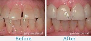 Cosmetic Dentistry, teeth whitening, veneers, dental implants, Invisalign, porcelain crowns, dental bonding, teeth reshaping, smile makeover, teeth straightening, teeth contouring, teeth reshaping, teeth restoration, dental aesthetics, oral aesthetics, de