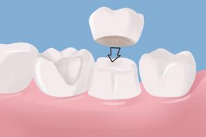 Revitalize Your Smile with Strong & Aesthetic Crowns. Trust the Expertise of Dr. Matthew S. Wittrig, DDS in Greenwood, IN for Personalized Dental Care & Durable Solutions for Improved Oral Health & Function.