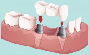 Transform Your Smile with Durable & Aesthetic Bridges. Experience Improved Oral Health & Function at Dr. Matthew S. Wittrig, DDS in Greenwood, IN. Get Expert Dental Care & A Stunning Smile Today with Bridges!